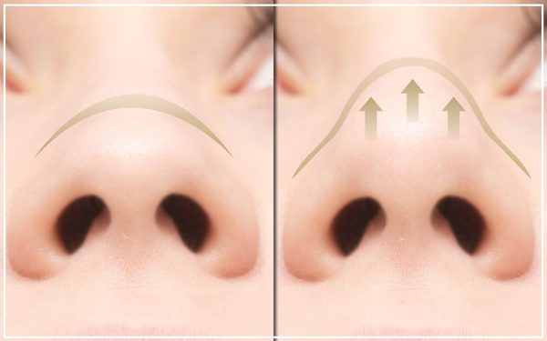 鼻尖縮小手術(鼻尖形成手術)