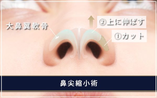鼻尖縮小手術の方法