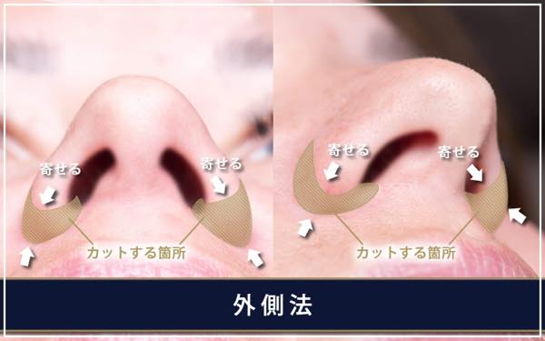 鼻翼縮小手術 - 外側法 -