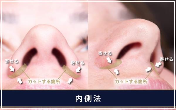 鼻翼縮小手術 - 内側法 -